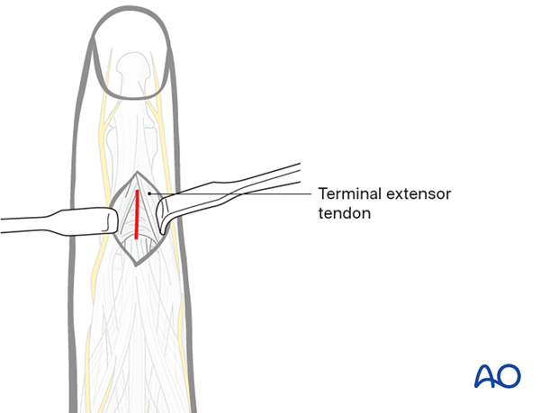 Make a 1 cm dorsal incision distal to central slip insertion, incising the triangular ligament.