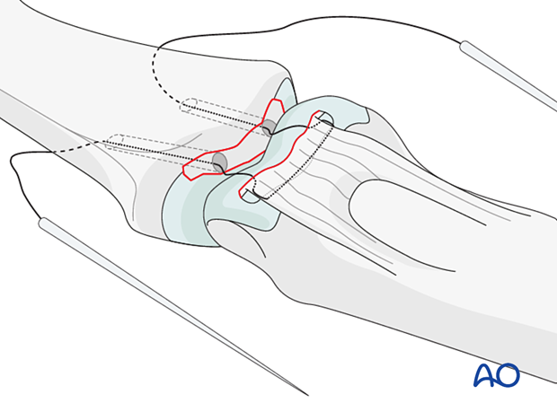 Wrap 4.0 braided nonabsorbable sutures around fragment, insert ends through drill holes, exit dorsally.