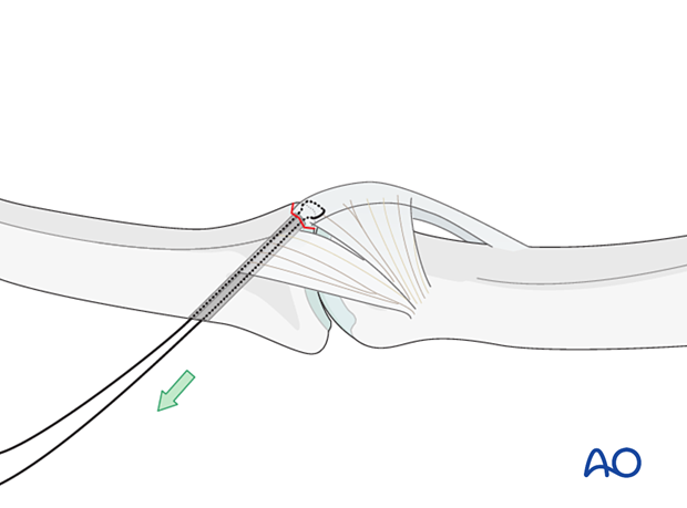 Gently reduce fracture by pulling sutures dorsally, confirm anatomical reduction with image intensification.