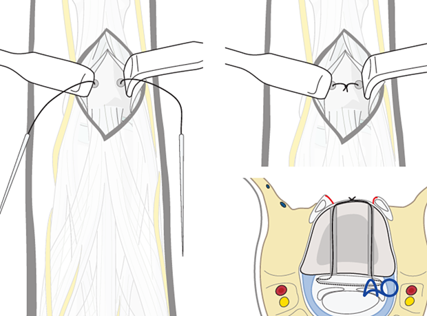 Confirm volar plate length and fixed flexion under 30°, then tighten sutures over middle phalanx dorsal cortex. Resuture triangular ligament if possible