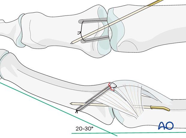 Transfix joint for 4 weeks to protect ligament repair, risking stiffness. Pass 1.2 mm K-wire obliquely across PIP joint in 20°–30° flexion. Leave K-wire end outside skin for removal. Protect fixation with splint to prevent wire breakage