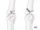 Volar plate arthroplasty of a multifragmentary articular fracture of the middle phalangeal base