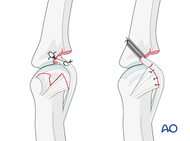 Two techniques for collateral ligament reattachment: suture anchors (easy) or bone tunneling (cheaper)