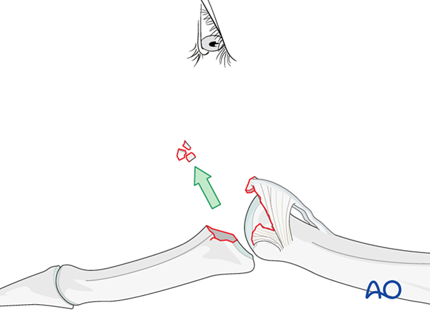 Hyperextend middle phalanx for joint visualization. Remove loose bony fragments, keep ligament-attached fragments