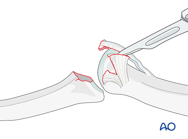 Incise between volar plate and accessory collateral ligament to allow volar plate mobilization