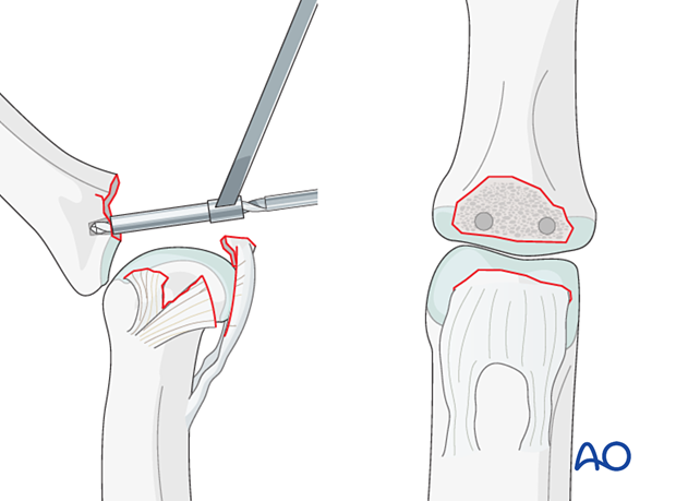 Keep PIP hyperextended to visualize fracture base. Drill pilot holes for anchors