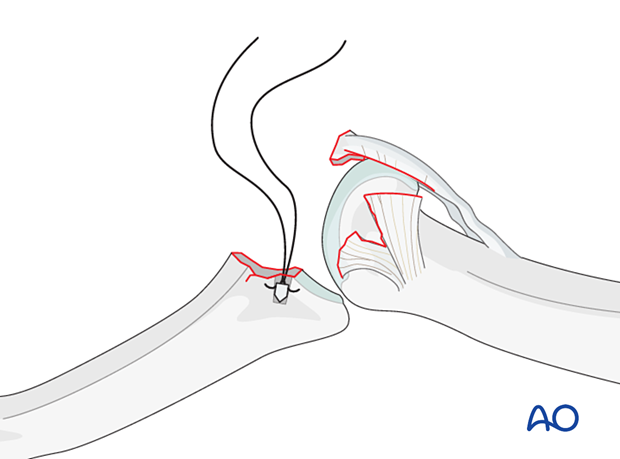 Insert anchors per manufacturer's instructions, close to subchondral bone. Ensure anchor is fully buried