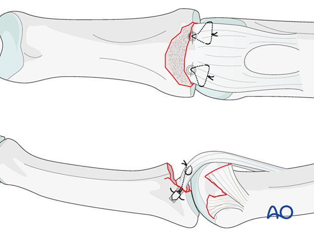 Insert sutures into volar plate. Reapproximate ligament to phalanx, loop thread ends, tie knot. Ensure volar plate is close to subchondral bone for smooth mobility