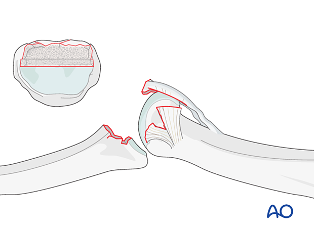 Shape transverse groove in subchondral bone at middle phalanx base with rongeur, perpendicular to long axis