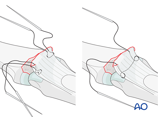 Use fine braided sutures with double-mounted straight needles to insert crisscross (Bunnell) stitch in volar plate from distal to proximal and back