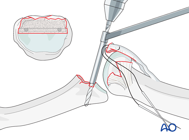 Keep phalanx hyperextended, drill holes in ulnar and radial ends of transverse groove. Use drill guide to protect condyle cartilage. Holes should perforate dorsal cortex of middle phalanx