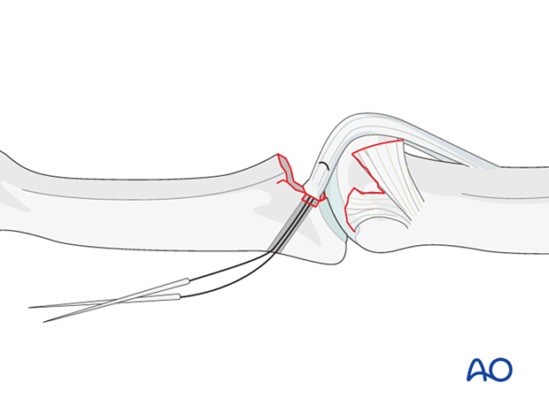 Position drill holes close to articular cartilage to prevent subluxation