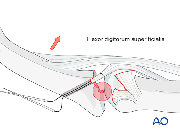 Pitfall: Drill holes not near articular cartilage can cause dorsal subluxation and later degenerative joint disease