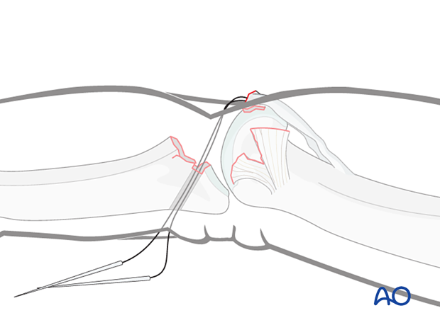 Thread needles through holes to exit via dorsal incision
