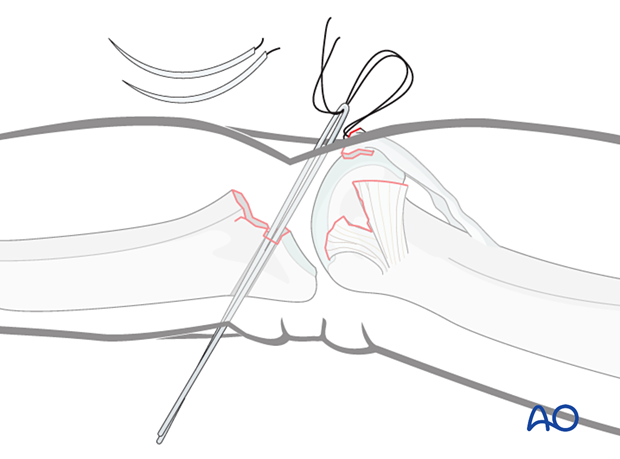 Use wire loops through drill holes if straight needles aren't available. Pull loops out dorsally.