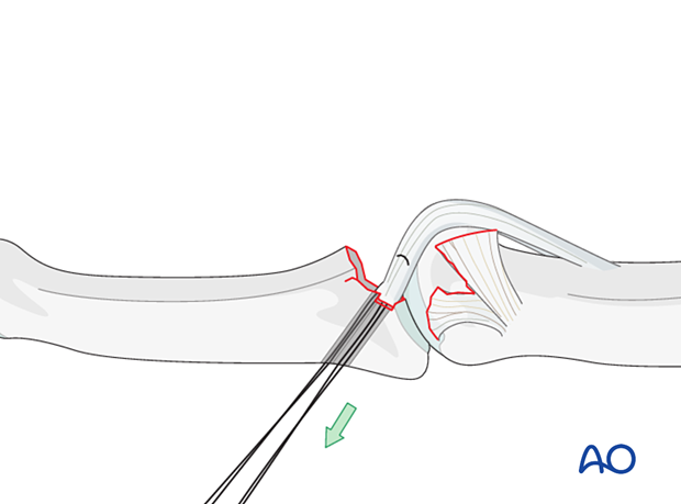 Traction on sutures draws volar plate into groove. Confirm plate entry and joint congruency with imaging