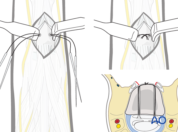 Confirm volar plate length and fixed flexion under 30°, then tighten sutures over middle phalanx dorsal cortex. Resuture triangular ligament if possible
