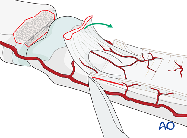 If treatment is delayed, mobilize checkreins if volar plate is shortened and can't reach the groove