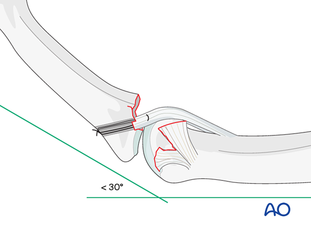 Consequences of flexing a finger beyond 30° with a shortened volar plate.