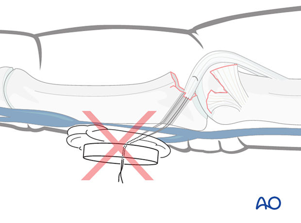Pressure from a button on pull-out sutures can cause swelling; safer to tie suture over the bone