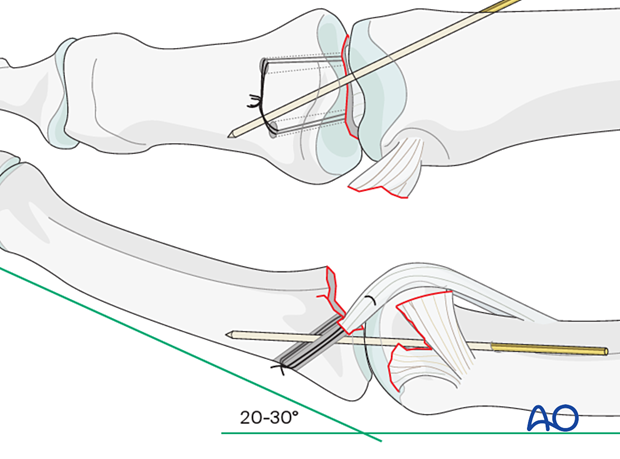 Insert K-wire across PIP joint obliquely with finger in 20°–30° flexion; remove after 4 weeks