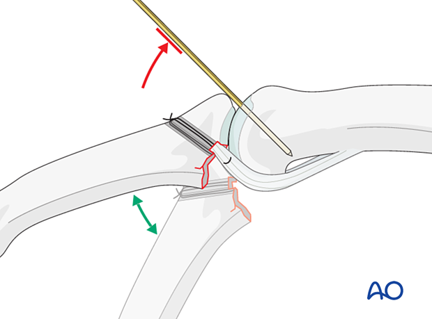 Extension block K-wire prevents dorsal subluxation, allows immediate PIP joint mobilization