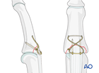 Cerclage compression wiring of a dorsal avulsion of the middle phalangeal base