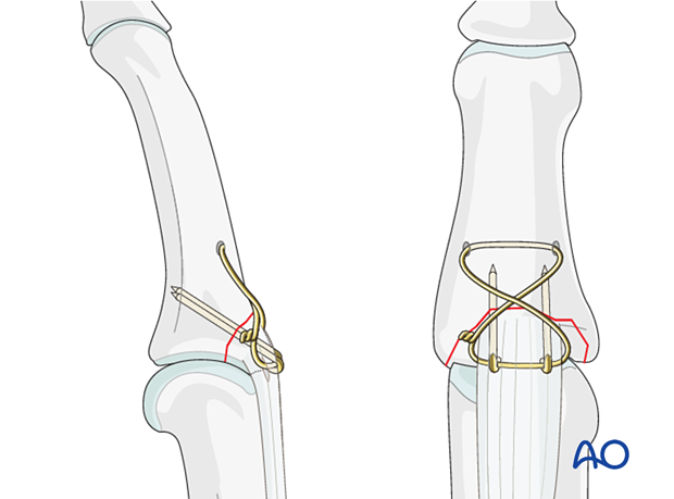 Stabilize partial articular fracture with cerclage compression wiring; remove bulky wires later.