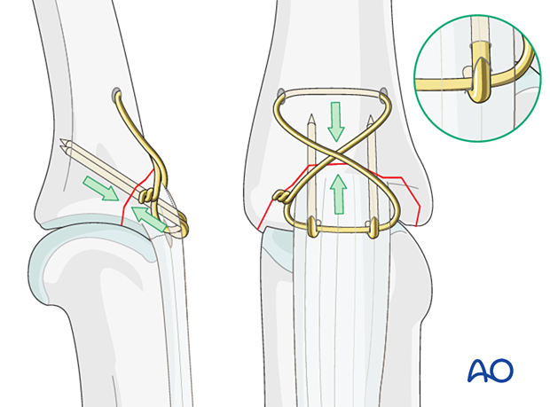 Tension band converts tensile forces into compression; now termed cerclage compression wire fixation