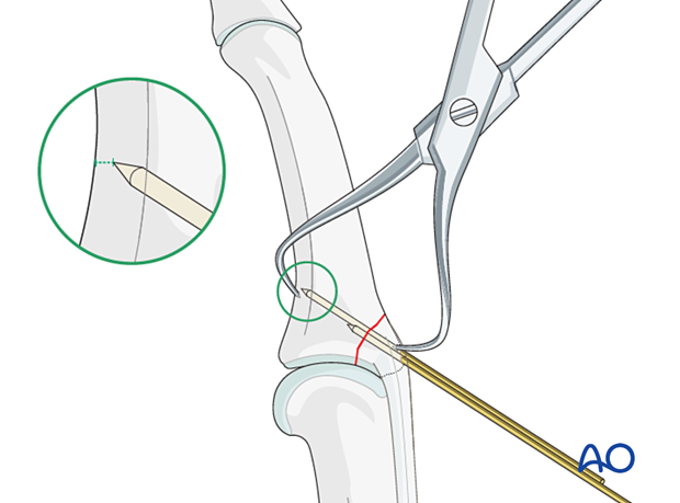 Hold reduction by inserting two K-wires perpendicular to fracture surface; check reduction with image intensification