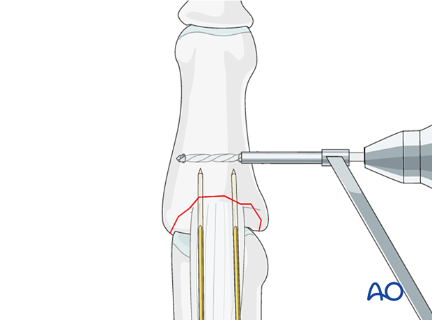 Use a drill guide for soft-tissue protection with a slow-spinning 1.5 mm drill or a 1 mm K-wire