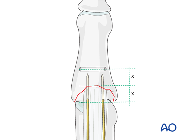 Drill hole location should match avulsed fragment's length (approx. 1 cm) for optimal wire force distribution