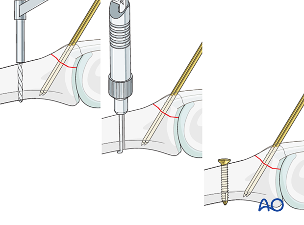Insert screw 1 cm from fracture line for cerclage wire anchorage; follow standard screw inserting technique