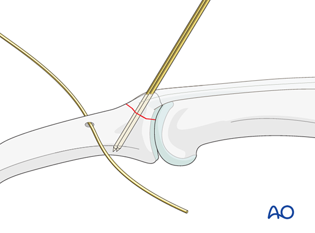 Pass 0.6 mm stainless steel wire through hole or use 4.0 nonabsorbable multifilament suture on straight needle