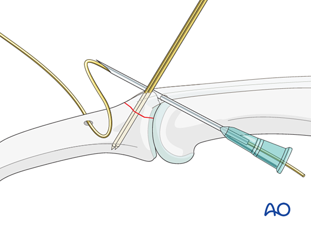 Pass wire through central slip and K-wires near bone insertion; avoid placing wire on top of central slip