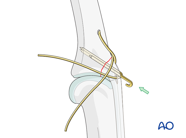 Check K-wire position with image intensification; retract, bend, cut, and impact tip into bone if needed
