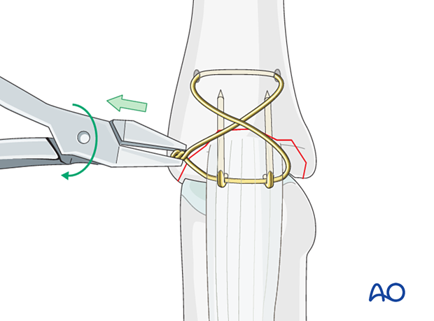 Use pliers to tighten wire loop with traction; twist under tension to take up slack