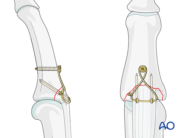 Anchor figure-of-eight wire distally in the phalanx using a screw instead of a drill hole