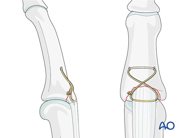 Use a simple figure-of-eight tension band if the avulsed fragment is too small for a K-wire