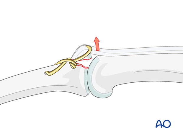 Avulsed fragment may tilt when wire is tightened if no K-wires are used for anchoring cerclage wire