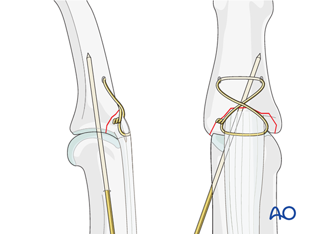 Insert K-wire obliquely across PIP joint with finger in extension; remove after 3–4 weeks; protect with splint