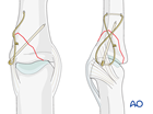 Cerclage compression wiring of a collateral ligament avulsion of the middle phalangeal base