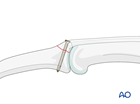 Lag-screw fixation of a dorsal avulsion of the middle phalangeal base