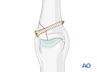 Lag-screw fixation of a collateral ligament avulsion of the middle phalangeal base