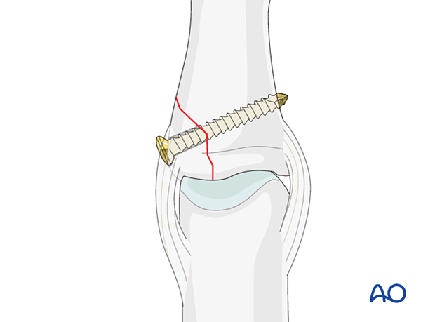 Lag-screw fixation of middle phalangeal base fracture; anatomical reduction needed; plate fixation for chondral support.