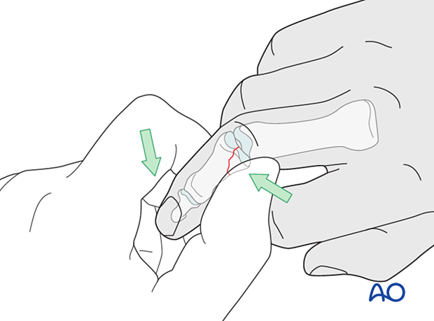 Lag-screw fixation of middle phalangeal base fracture; reduction by lateral pull and PIP flexion; fragment pushed by thumb.
