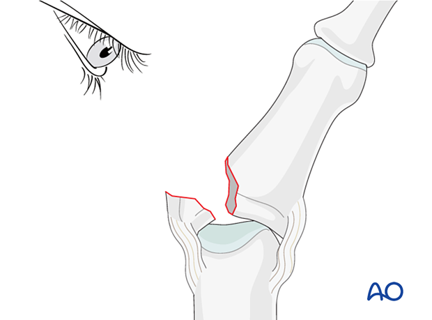 Lag-screw fixation of middle phalangeal base fracture; open reduction; lateral deviation for joint visualization; evaluate geometry.