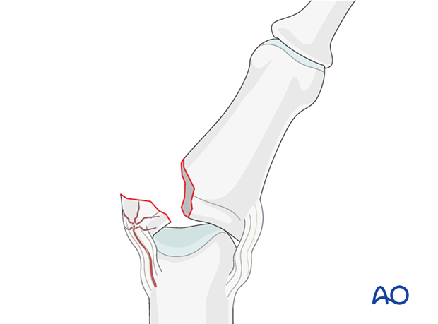 Lag-screw fixation of middle phalangeal base fracture; risks include dissection and devascularization, jeopardizing healing.
