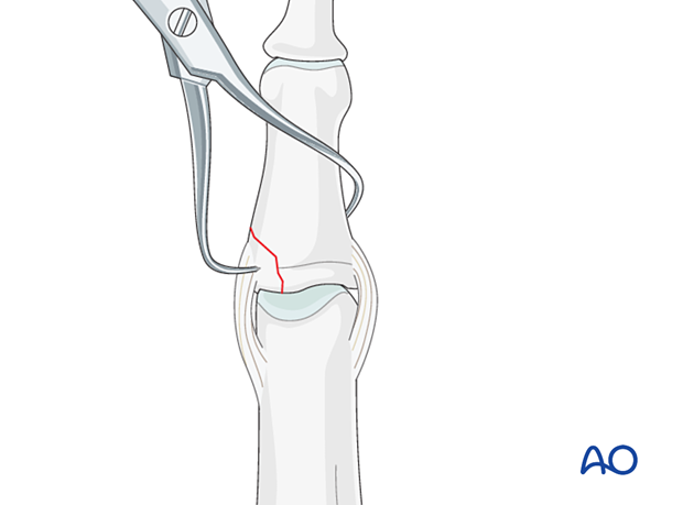 Lag-screw fixation of middle phalangeal base fracture; reduce with forceps; avoid excessive force; anatomical reduction crucial.