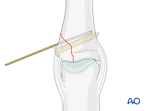 Lag-screw fixation of middle phalangeal base fracture; preliminarily fix fragment with K-wire; guide wire for reduction.